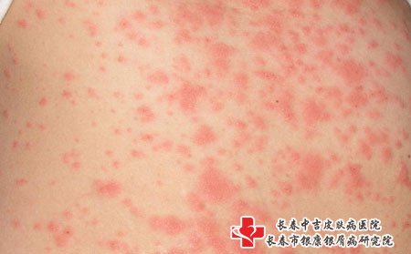 皮肤瘙痒可能是过敏引起的