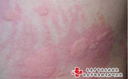荨麻疹分类,荨麻疹治疗,荨麻疹症状,荨麻疹表现