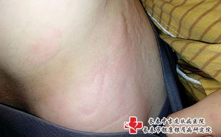 荨麻疹照片