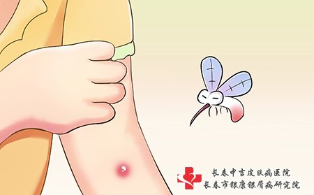 蚊虫叮咬会引起荨麻疹