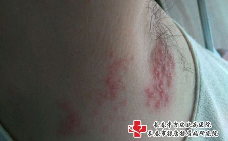 带状疱疹图片