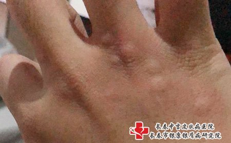 荨麻疹要避免诱因