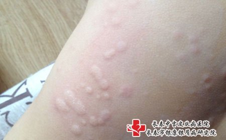 皮肤瘙痒图片