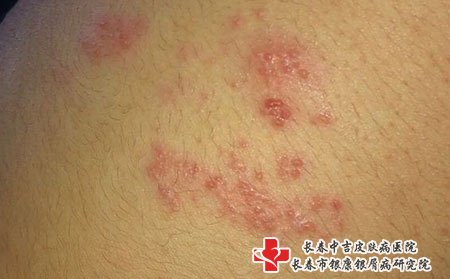 带状疱疹图片
