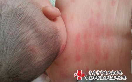 宝宝皮肤瘙痒是过敏引起