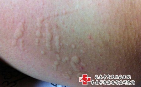 皮肤瘙痒图片