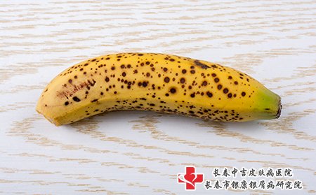 雀斑就像香蕉上的点点