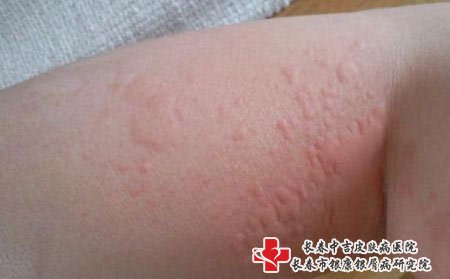 皮肤瘙痒图片