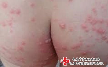 皮肤瘙痒可能是湿疹引起