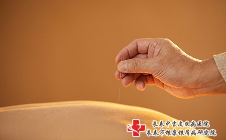 雀斑可以通过针灸治疗