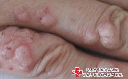 扁平疣病因,为什么会得扁平疣