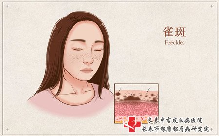 为什么长雀斑,长雀斑的原因