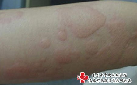 荨麻疹图片