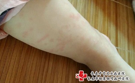 荨麻疹图片