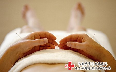 荨麻疹可以针灸治疗