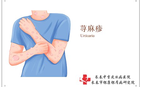 荨麻疹要及时治疗