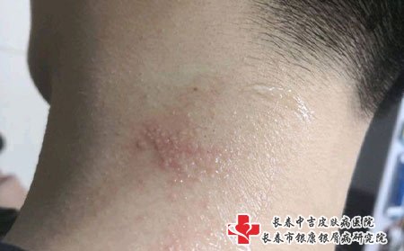 带状疱疹图片