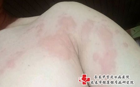 荨麻疹图片