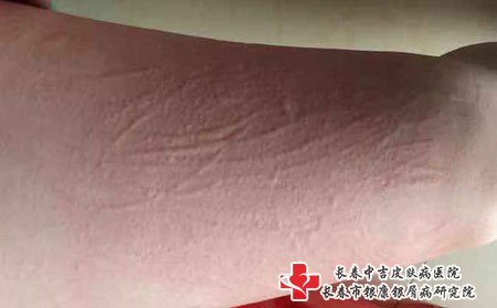 荨麻疹图片