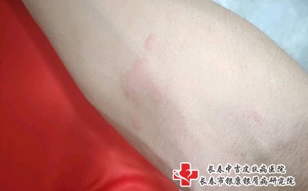 荨麻疹图片
