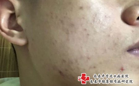 痤疮图片
