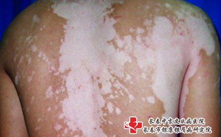 白癜风图片