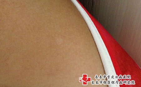 白癜风图片
