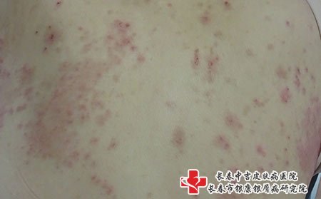 湿疹图片
