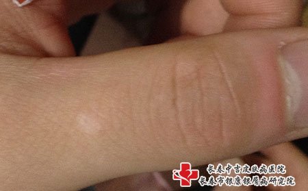 白癜风图片