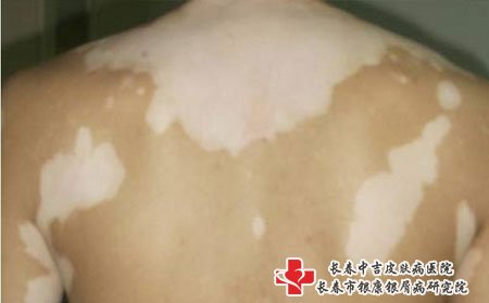 白癜风图片