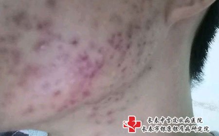 痤疮图片
