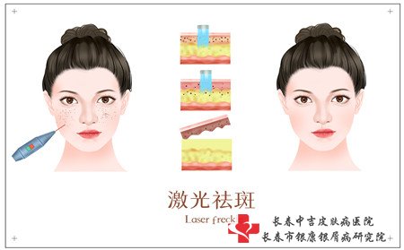 雀斑病因,雀斑的病因有什么