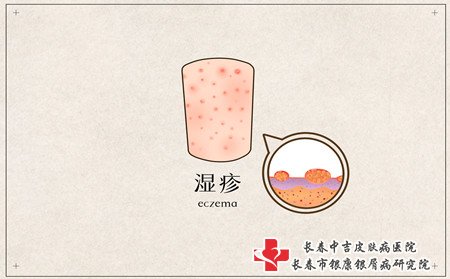 湿疹病因,产生湿疹的原因