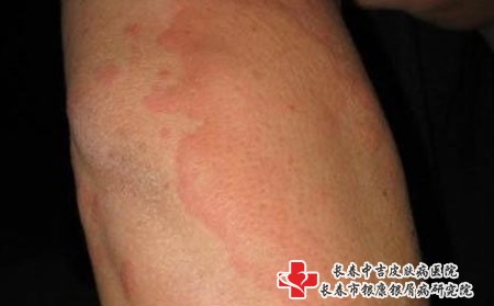 荨麻疹图片