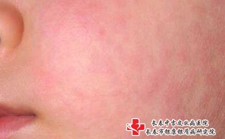 脸上瘙痒也可能是荨麻疹
