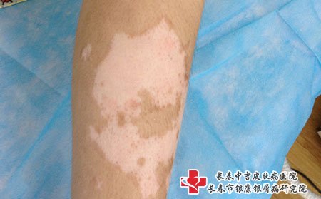 白癜风不建议半途停药