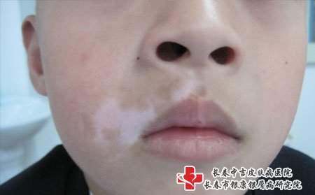 白癜风要注意治疗方法