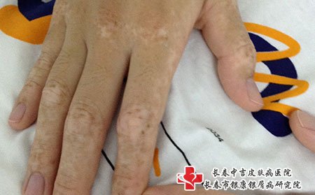 白癜风图片