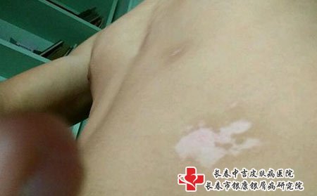 白癜风图片