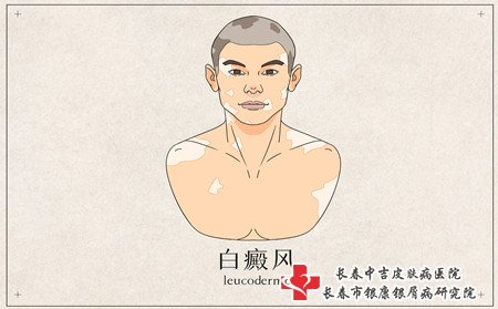 面部白癜风怎么办,脸上长白癜风怎么办