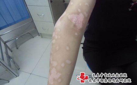 白癜风要护理皮肤
