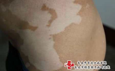 白癜风图片