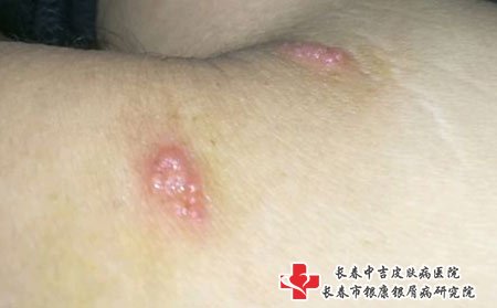 带状疱疹图片