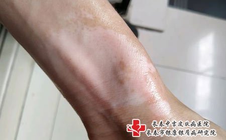 白癜风图片
