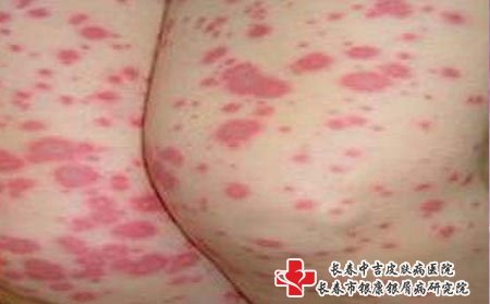 皮肤瘙痒图片