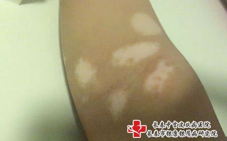 白癜风图片