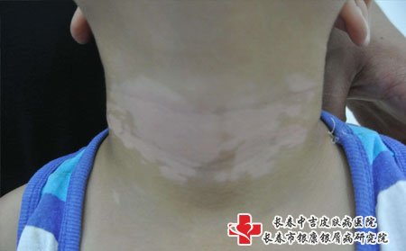 白癜风图片