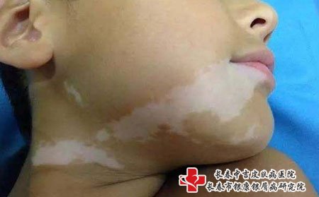 儿童白癜风治疗,儿童有白癜风怎样治