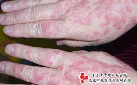 皮炎症状,皮炎症状表现