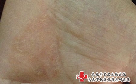 湿疹图片